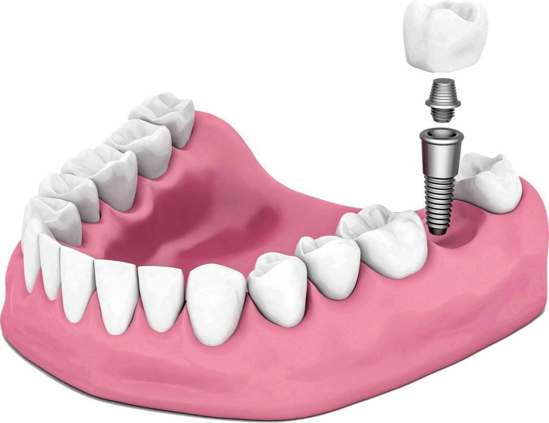 口腔種植的生物(wù)學(xué)是什麽