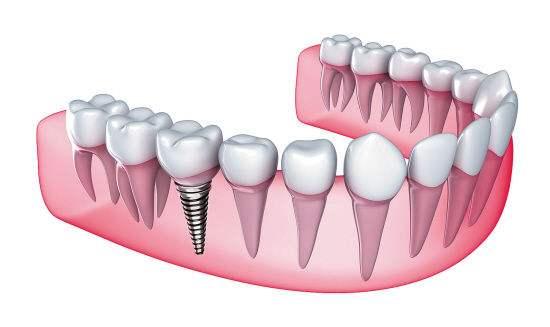 口腔種植的成功率高嗎