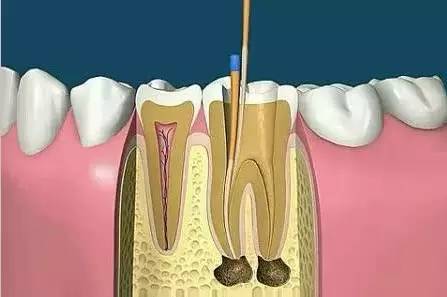 根管治療的适應證是什麽