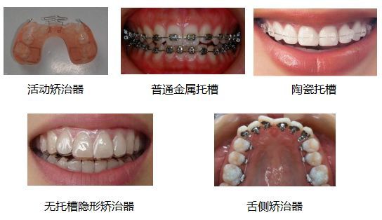 自鎖托槽矯治、無托槽隐形矯治與舌側矯治分(fēn)别是什麽樣的