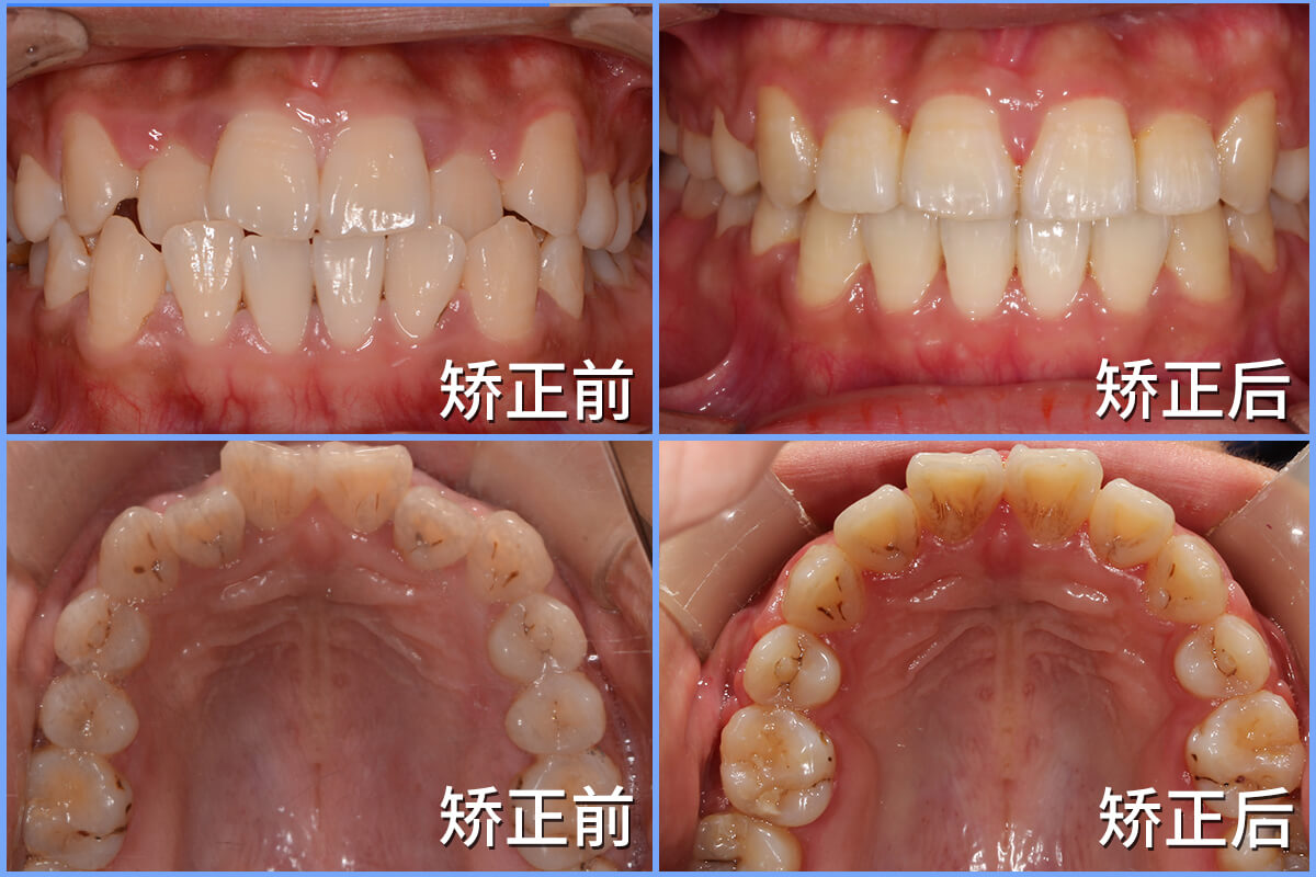 牙齒矯正的目的是什麽