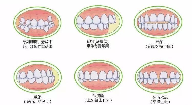 錯颌畸形的先天因素是指什麽