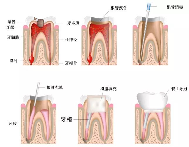 根管治療的适應證和非适應證