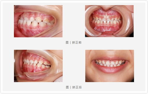 前牙反颌的病因是什麽