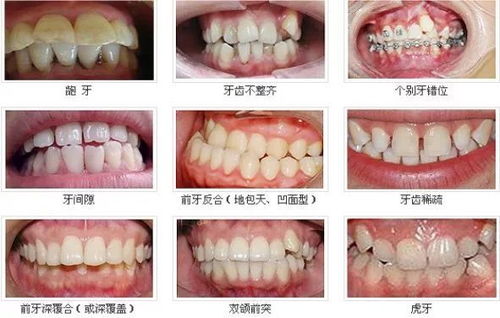 錯颌畸形會造成什麽危害