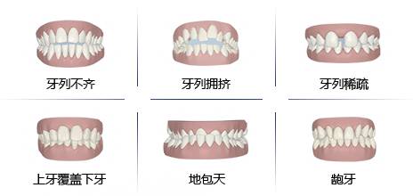 常見錯颌畸形及治療是什麽