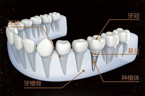 為(wèi)什麽種植牙價格昂貴