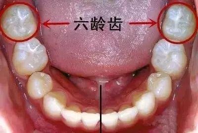 為(wèi)什麽要特别注意保護兒童“六齡牙”