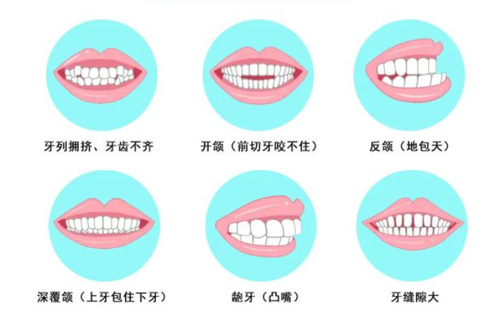 常見異常咬合與牙列不齊、錯颌畸形的種類