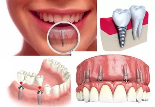 種植義齒成功的要素是什麽