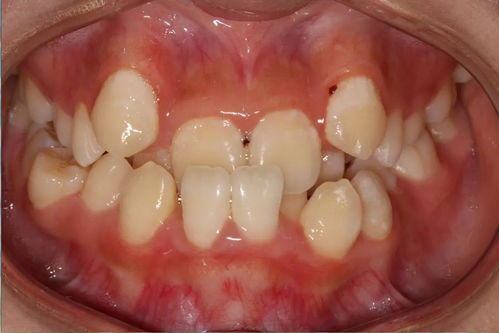 前牙反颌的臨床表現及治療原則