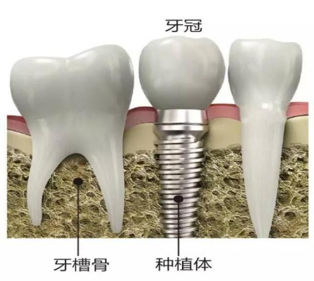 影響種植牙壽命長(cháng)短的因素是什麽