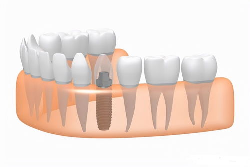 種植牙科(kē)普：種植體(tǐ)材料如何影響種植牙的壽命？