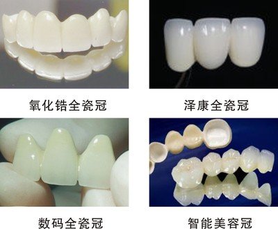 如何選擇适合自己的全瓷牙修複方式？全瓷牙修複後怎麽護理(lǐ)？