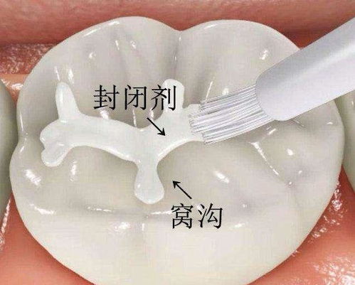 窩溝封閉和補牙有(yǒu)什麽區(qū)别？兒童和青少年補牙後需要注意什麽？