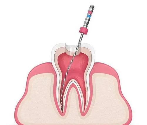 牙科(kē)小(xiǎo)知識：牙髓感染後進行根管治療的風險有(yǒu)哪些？